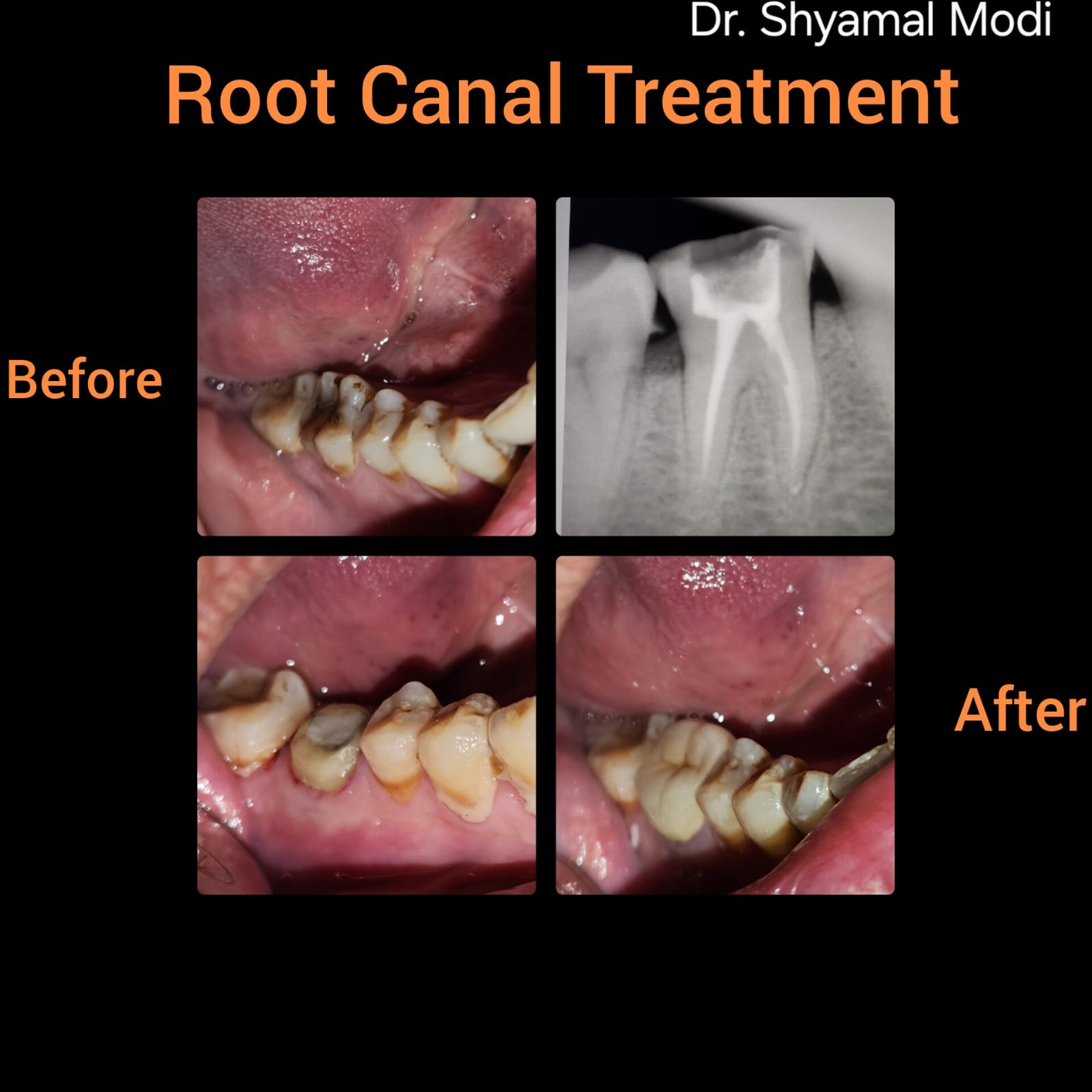 Root Canal Treatment