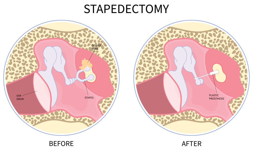 Stapedotomy