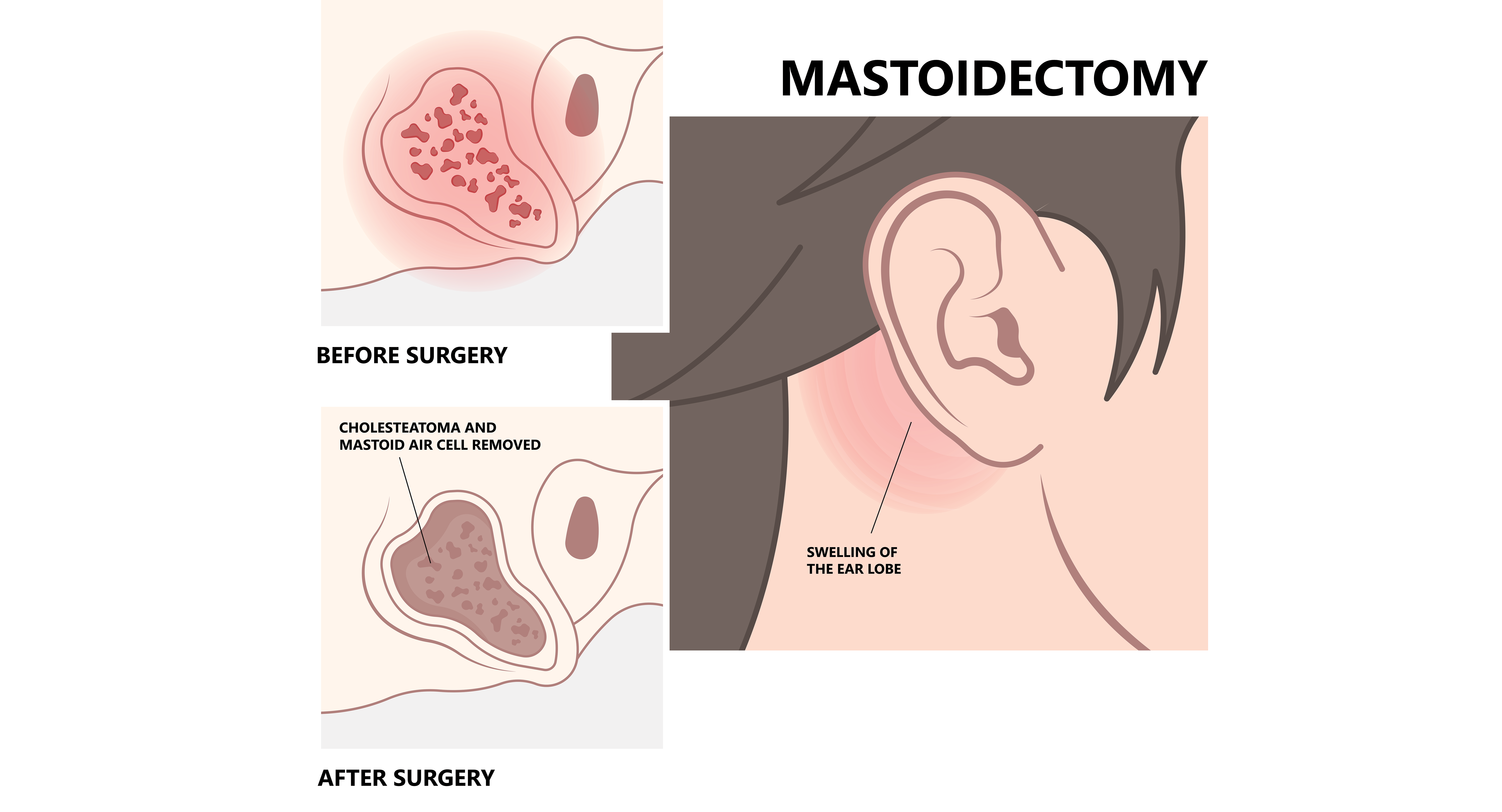 Mastoidectomy