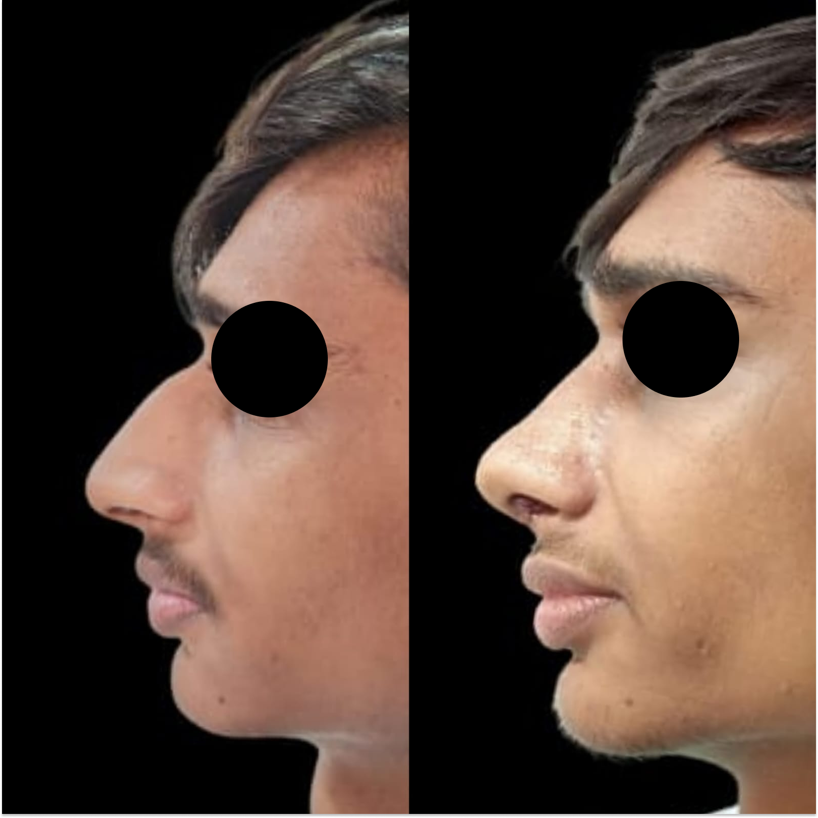 Septo Rhinoplasty